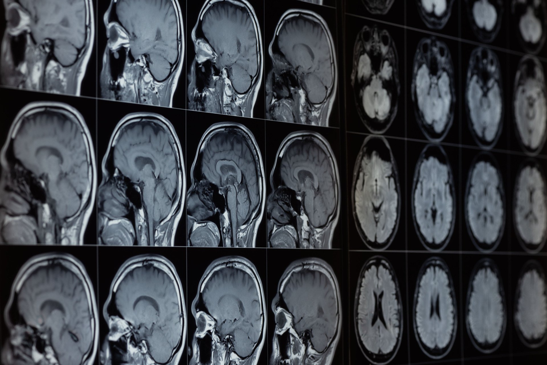 Pesquisadores de Harvard Descobrem Potencial do Lítio no Combate ao Alzheimer