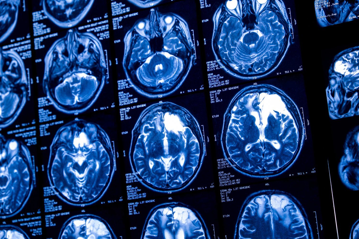Sam Altman Lança Startup de Implantes Cerebrais para Concorrer com Neuralink de Musk